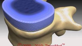 How a disc gets damaged cause and cure for slipped disc AKA slip disc [upl. by Uzzia]