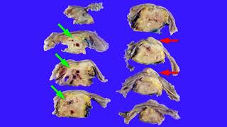 Two causes of obstructive jaundice amp chronic pancreatitis  adenomyoma amp autoimmune pancreatitis [upl. by Garek]