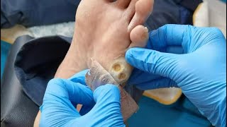 Pedicure Tutorial How to treat plantar wart Plantar wart removal Two warts on the sole [upl. by Ylellan]