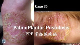 Palmoplantar pustulosis PPP 掌跖脓疱病 [upl. by Nedaj]