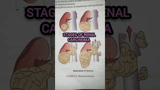 Stages of Renal Carcinoma cancer kidney medical pathology shorts medicalshorts [upl. by Finzer]