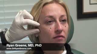 Juvederm VOLUMA Cheek amp Chin Augmentation in South Florida  Dr Ryan Greene [upl. by Yrotciv93]