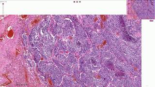 Small Cell Carcinoma of the Lungs  Histopathology [upl. by Rebmyk]