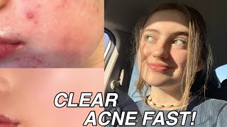 HOW TO REALLY CLEAR ACNE FAST   skincare routine [upl. by Berkshire422]