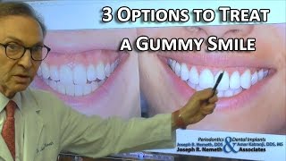 3 Options to Treat a Gummy Smile Doctors Advice [upl. by Sinnard]