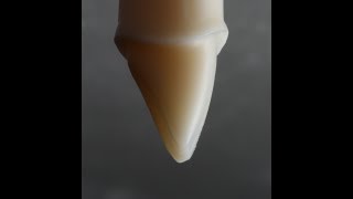 All Ceramic Crown Preparation for Emax and Zirconia [upl. by Gowon]