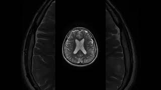 Tuberous sclerosis mribrain shoets [upl. by Cralg]