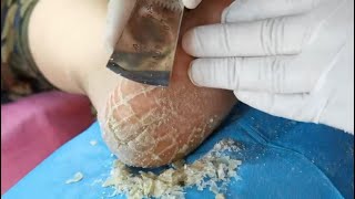 SO SATISFYING 7 mins Followup coming Look at the heel amp its dead skin Cracked heel treatment [upl. by Joelly]