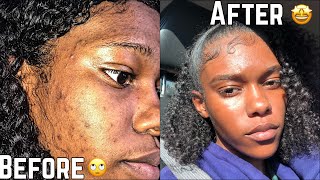 SKIN  How To Get Rid Of Hyperpigmentation Dark spots less than a month  FAST [upl. by Zantos]