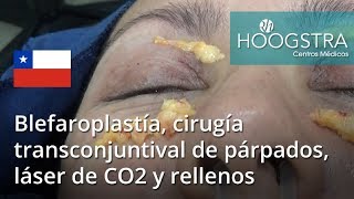 Blefaroplastía cirugía transconjuntival de párpados láser de CO2 y rellenos 17053 [upl. by Nwahs]