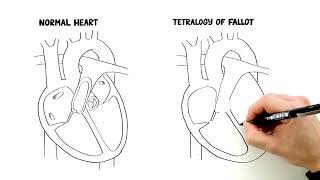 What is Tetralogy of Fallot [upl. by Esile]