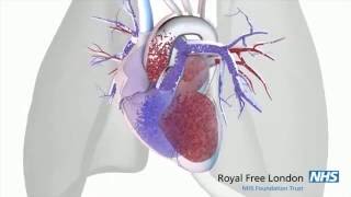 What is pulmonary hypertension [upl. by Hannus]