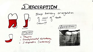 dilaceration dental  dilaceration  Developmental Disturbance of Teeth [upl. by Manuel]