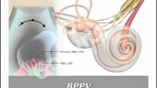 BPPV and Epleys Maneuver [upl. by Rheims435]