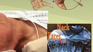 Cervical Radiofrequency Ablation [upl. by Adnoved940]