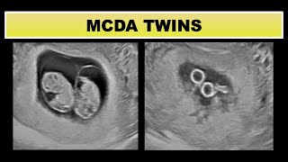 Monochorionic Diamniotic twin pregnancy [upl. by Atiuqer308]