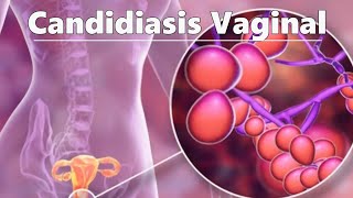 Candidiasis Vaginal y Medicamento que debes Tomar 👨‍⚕️ Consultorio Médico [upl. by Narak]