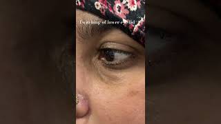 Twitching of lower eye lideyelid myokymia [upl. by Eldreda217]