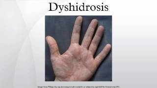 Dyshidrosis [upl. by Llednew]