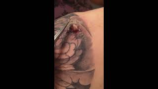 Infected abscess on tattoo [upl. by Ibba]