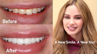 Veneers and Crowns  Stunning Smile Enhancement  Live Cosmetic Dentistry [upl. by Anayd]