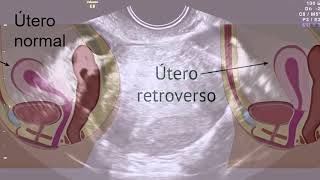 ¿Sabías que el útero en retroversión es un mito [upl. by Otrevogir325]