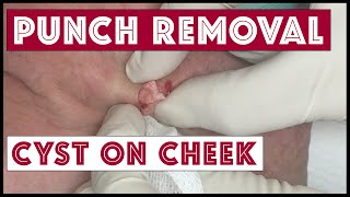 Second try cyst excision Punch biopsy tool used [upl. by Erhard]