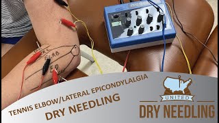 Tennis ElbowElbow PAIN Treatment with NEEDLES [upl. by Joela]