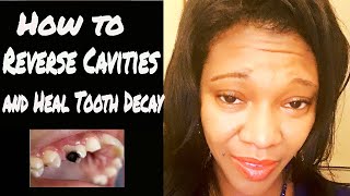 How to Reverse Cavities Naturally and Heal Tooth Decay Remedy for Teeth cavities dentist [upl. by Omsare]