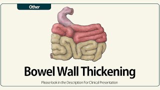 Linear EUS Bowel Wall Thickening [upl. by Briny]