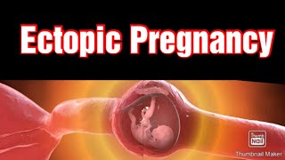 Ectopic Pregnancy  Pregnancy Outside Uterus NORMAL OR ABNORMAL Complete Lecture nursingstudies [upl. by Laddy]