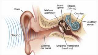 Auditory Neuropathy Spectrum Disorder Simulation [upl. by Haidabo949]