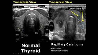 Thyroid Ultrasound Normal Vs Abnormal Image Appearances Comparison  Thyroid Pathologies USG [upl. by Nahpets545]