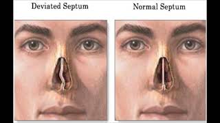 Does a Septoplasty Surgery Affect Your Singing Voice [upl. by Rog]