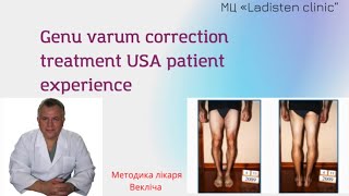 Genu varum correction treatment  USA patient experience [upl. by Grevera]