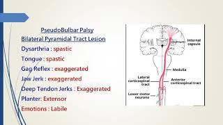 Pseudobulbar Palsy [upl. by Canotas]