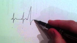 Cardiologist draws and explains the ECG of a ventricular ectopic beat [upl. by Gaelan]