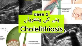 Cholelithiasis Gall bladder stones l Gall bladder pain پتے کا درد اور سوزش پتے کی پتھریاں [upl. by Bea]