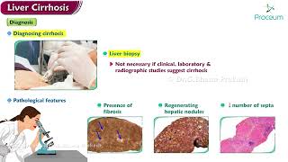 Liver cirrhosis  Etiology  Pathology  Clinical manifestations  Diagnosis  Treatment [upl. by Becki970]