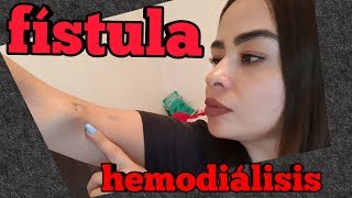 Dudas del paciente en HEMODIALISIS  que es la FISTULA ARTERIAL   Alejandra irc [upl. by Shurwood958]