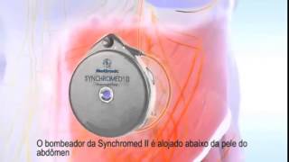 How a Baclofen Pump Works pt [upl. by Enida]