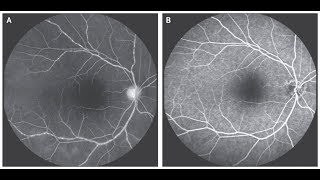 Vaskulitis der Retina bei Takayasu Arteriitis [upl. by Anele861]