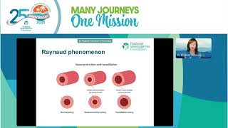 The Pregnancy Journey in Scleroderma from planning to Raising Children Elizabeth Volkmann MD MS [upl. by Ecitnerp]