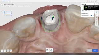 Designing a temporary crown with a screw channel on Medit ClinicCAD [upl. by Broeder214]