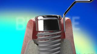 Dental Implant Surgery  REPAIR Implants Waterlase Laser Dentistry [upl. by Beetner345]