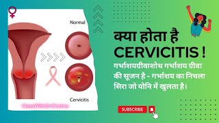 What Is Cervicitis  Kaise Cervicitis ko Thik kare  kya Lakshan Hote hai Cervicitis ke [upl. by Peckham]