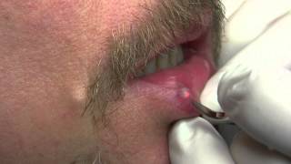 Venous Lake of Lip and Lip Freckle Removal with Iridex Laser [upl. by Adnol687]