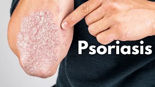 Psoriasis kya hai  Psoriasis kyu hota hai  Psoriasis ka ilaj  Psoriasis symptoms treatment [upl. by Nodnerb607]