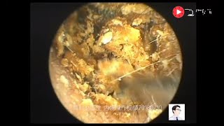 Removal of external auditory canal cholesteatoma by ear endoscopy 19 minutes [upl. by Schram]