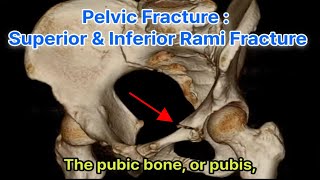 Pelvic Fracture  Superior and Inferior Rami Fracture [upl. by Tamarah]